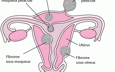 Les fibromes utérins