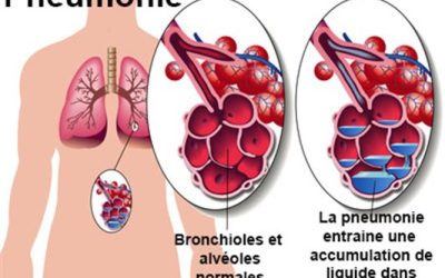 La pneumonie