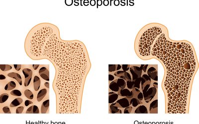 L’ostéoporose