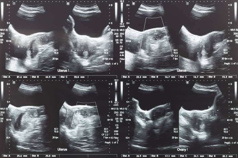Image montrant des résultats d'imagerie médicale, tels que des scans ou des échographies, illustrant le diagnostic de fibromes utérins.